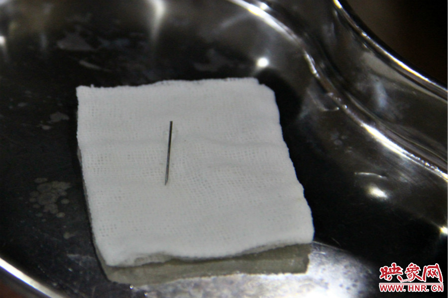 上午11點30分許，小龍腦中鋼針已經(jīng)成功取出。