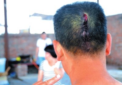 崔先生頭部受傷。京華時報記者趙思衡攝/視頻