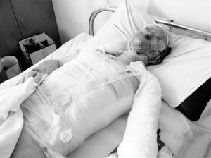 周小姐的頭、頸、軀干、四肢均被燒傷，其中面部燒傷最為嚴(yán)重。