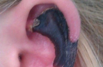 荷蘭女子旅游途中被蜘蛛咬，耳軟骨溶解變黑。