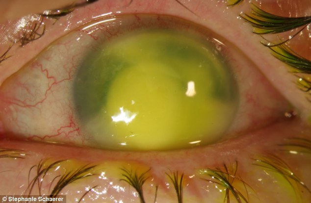 恐怖慎入！隱形眼鏡致英女子摘除眼球