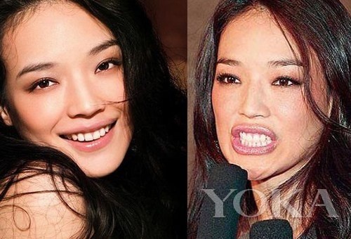 牙齒凸出，口輪肌過(guò)于松弛