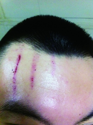 　2013年，被打者受傷照