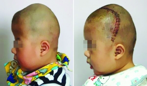 術前（左），術后（右）