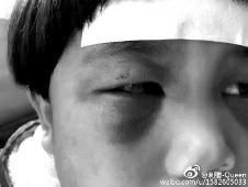 6月2日，網(wǎng)曝渭南市臨渭區(qū)一不滿5歲的女童遭奶奶毆打，眼圈青腫，引起網(wǎng)友關(guān)注，但孩子父母和爺爺均稱是摔倒導(dǎo)致。相關(guān)部門介入調(diào)查發(fā)現(xiàn)確為奶奶毆打所致，鑒于其身體原因已進(jìn)行批評(píng)教育。