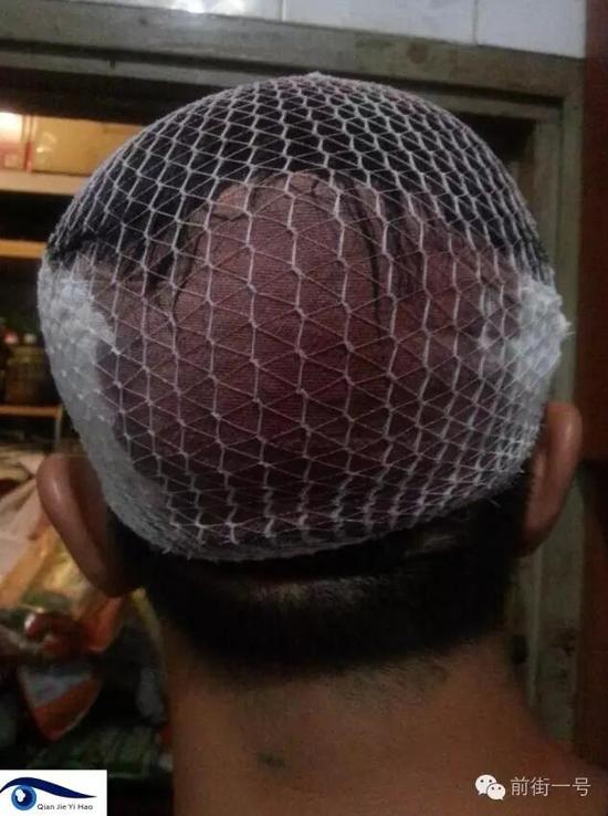 李律師受傷后縫合三針。