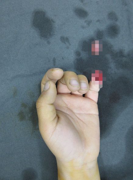 嚇哭！6歲男孩被夾斷手指 罪魁禍首竟是校服