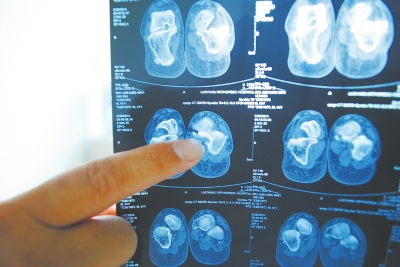 X光片顯示,確實有一根殘留的螺絲釘。