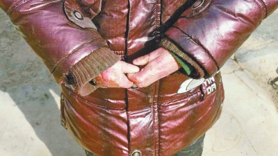 長期受損的手指，已經(jīng)長在了一起。