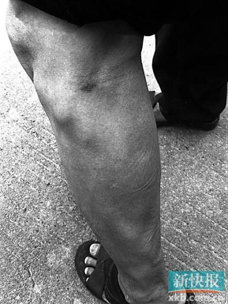 傷者身上遺留的彈痕。