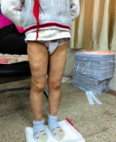 4月3日晚，微博網(wǎng)友“@朝廷半日閑”發(fā)圖文微博展示男童被虐待的慘狀。 微博截圖