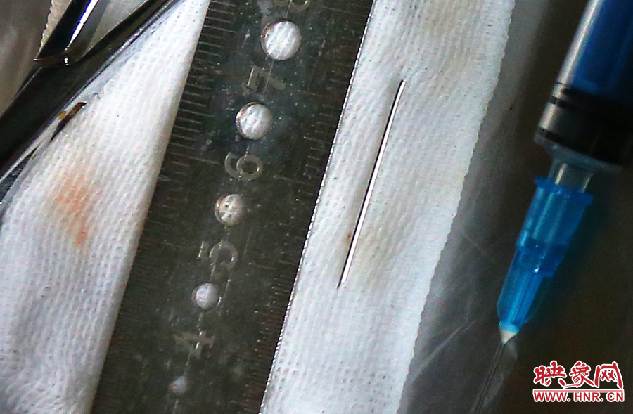 上午11點42分，大龍顱內(nèi)的鋼針被取出