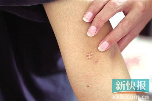 取出針后李星兒手臂留下了傷口。新快報(bào)記者 張國鋒/攝