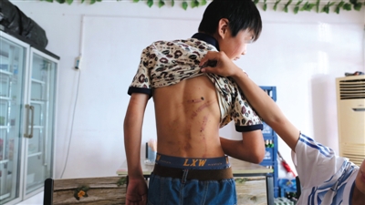 　昨日，奶西村，被打的小剛后背上條條瘀痕依然明顯。