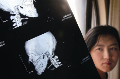 國(guó)內(nèi)醫(yī)院CT顯示，如今靳魏坤的鼻子假體是歪的，連下巴也是歪的