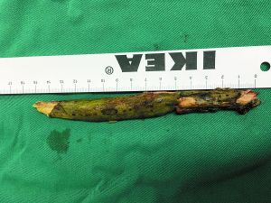 插入男子腦內(nèi)的樹(shù)枝。